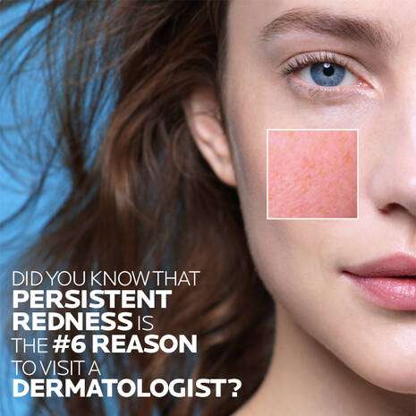 La Roche Posay Toleriane Rosaliac AR Moisturiser for Anti-Redness 40ml displayed on a model with redness-prone skin.