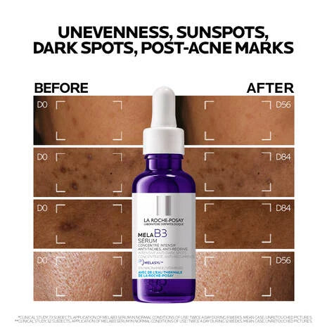 La Roche Posay Mela B3 Niacinamide Serum for Dark Spots 30ml before and after results with dark spots treatment