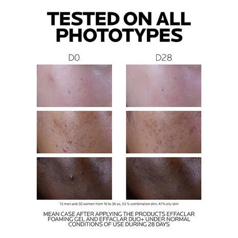 La Roche Posay Effaclar Duo+M Anti Imperfections Moisturiser 40ml before and after results on different skin types